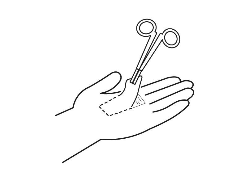 Colgajos locales extremidad superior abordaje anatómico quirúrgico. (observationship)